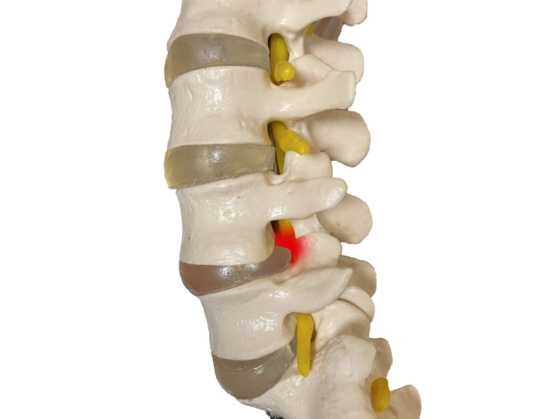 脊椎外科の治療対象となる症状と疾患の種類